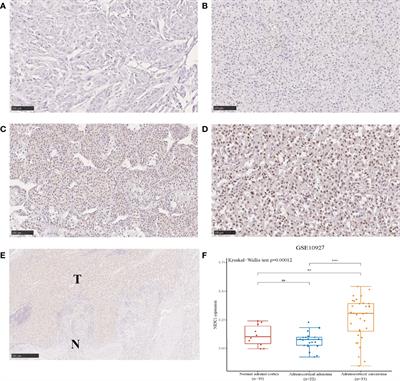 Expression of glucocorticoid receptor (GR) and clinical significance in adrenocortical carcinoma